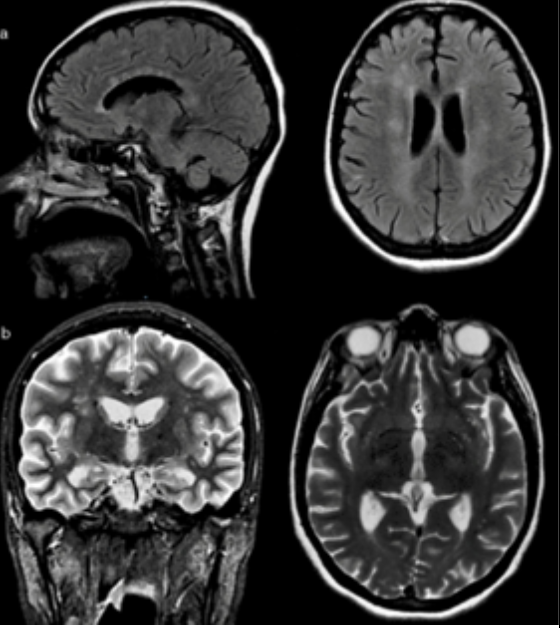 Imagen enc&eacute;falo MIR