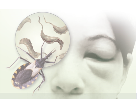 Dibujo chinche enfermedad Chagas y efecto en ojo humano (enunciado)